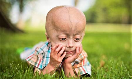 premature aging syndrome - progeria