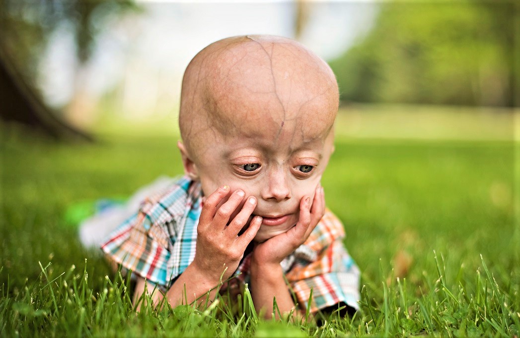 premature aging syndrome - progeria
