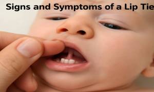 signs-and-symptoms-of-a-lip-tie