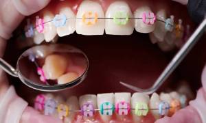 the-pros-and-cons-of-ceramic-braces