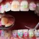 the-pros-and-cons-of-ceramic-braces