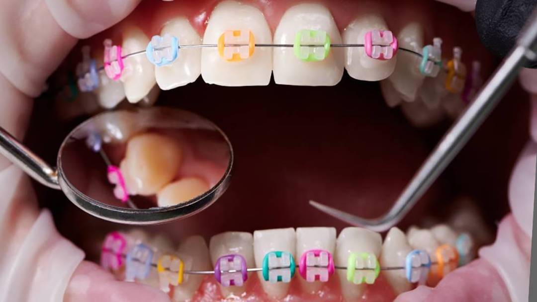 the-pros-and-cons-of-ceramic-braces