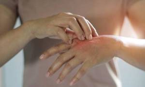 Natural Treatment for Psoriasis