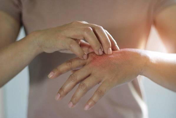 Natural Treatment for Psoriasis
