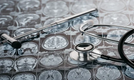 What is the Best Glioblastoma Treatment in the World? Exploring Leading Options