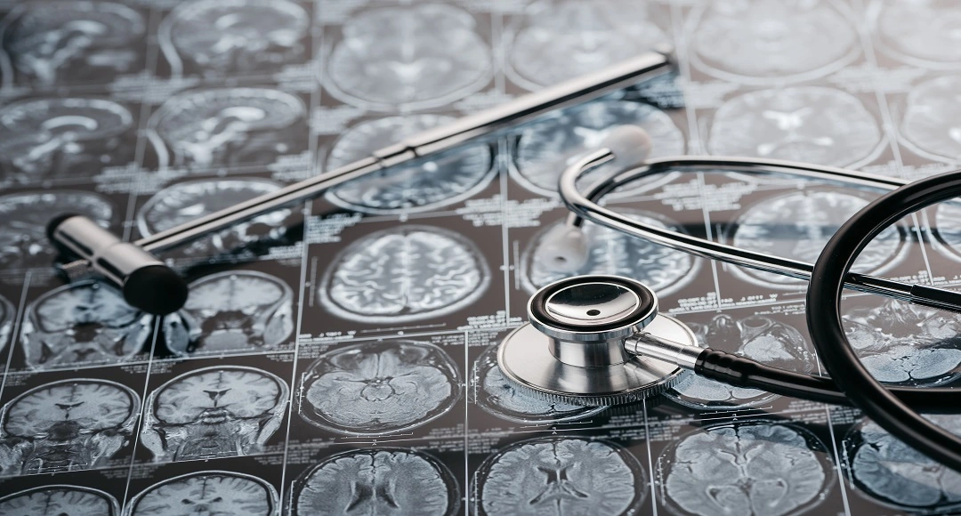 What is the Best Glioblastoma Treatment in the World? Exploring Leading Options