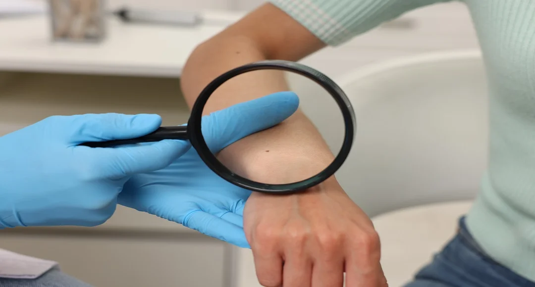 6 Dermatology Options Near Anderson, Indiana for Psoriasis, Eczema, and Chronic Skin Conditions in 2026